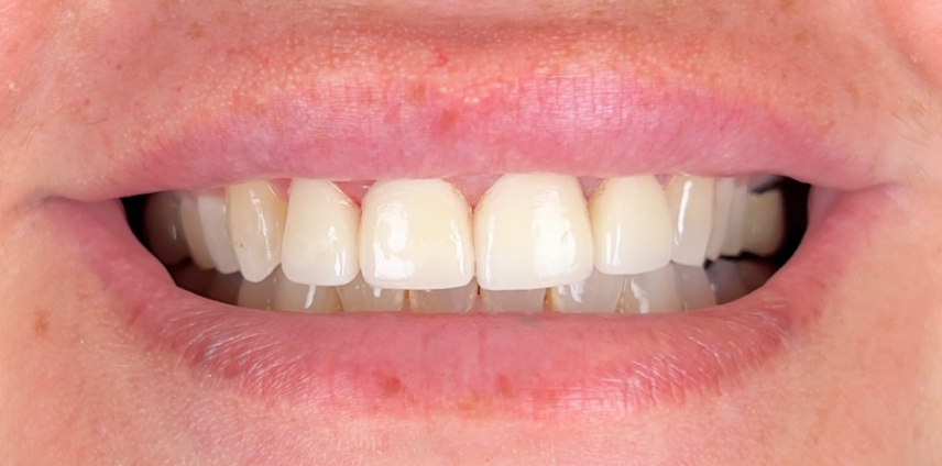 A close up of a person 's teeth with white teeth.