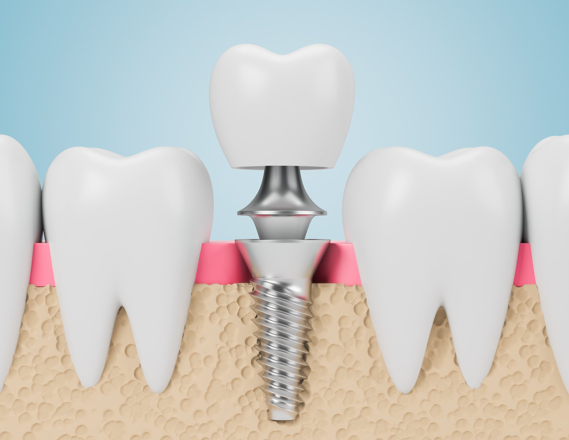 Zirconia or Titanium Dental Implants