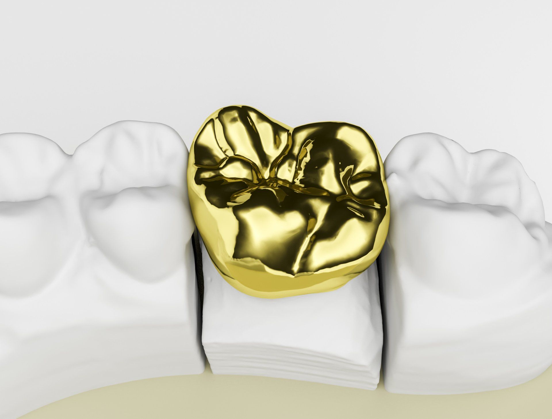 full cast metal dental restorations
