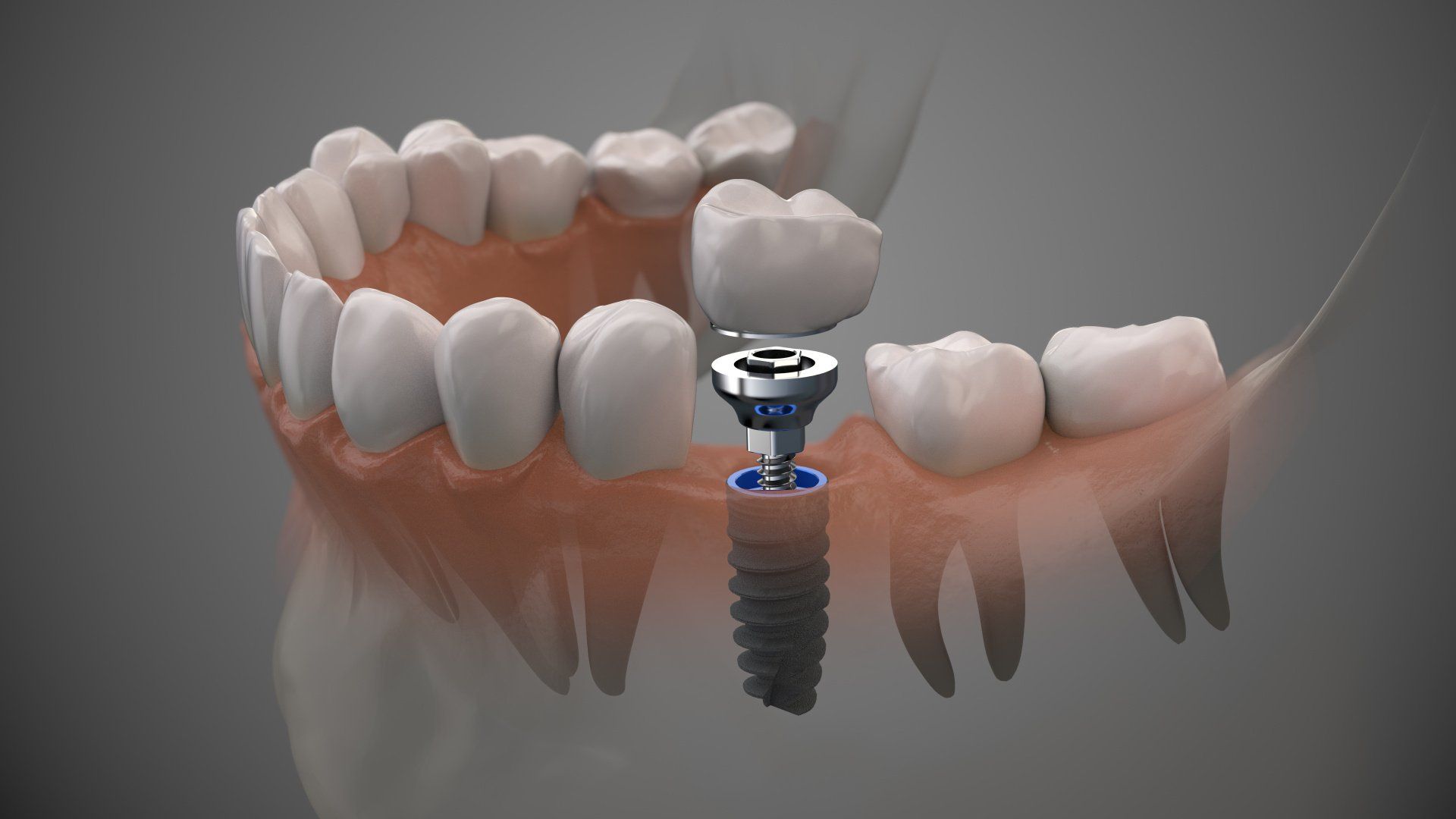 dental implant materials