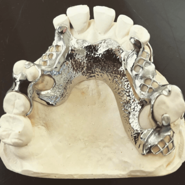 cast metal framework