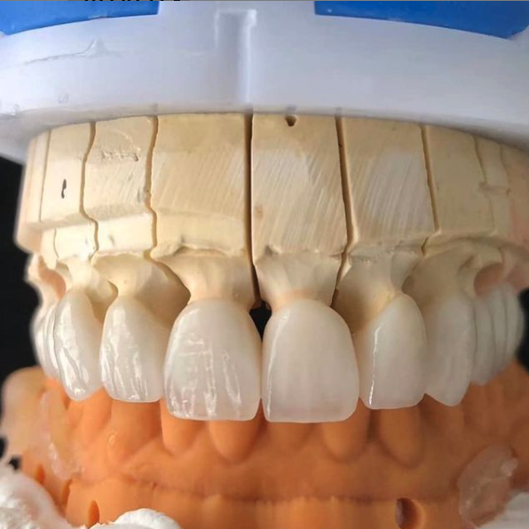 Fixed dental restorations