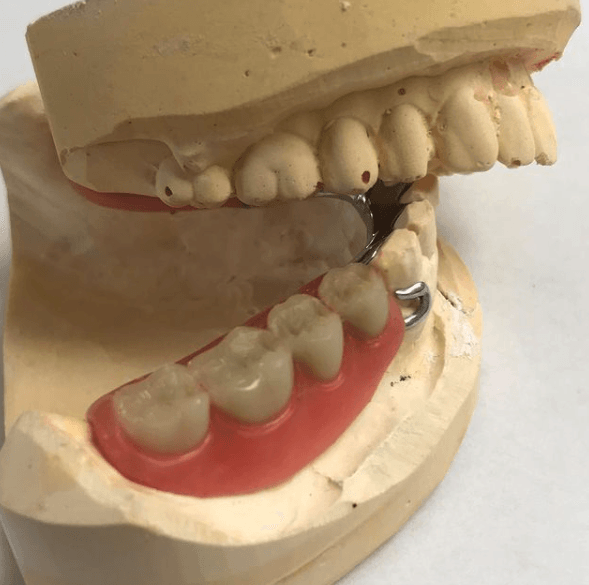 Partial dentures