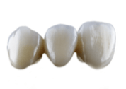 All Ceramic dental restorations