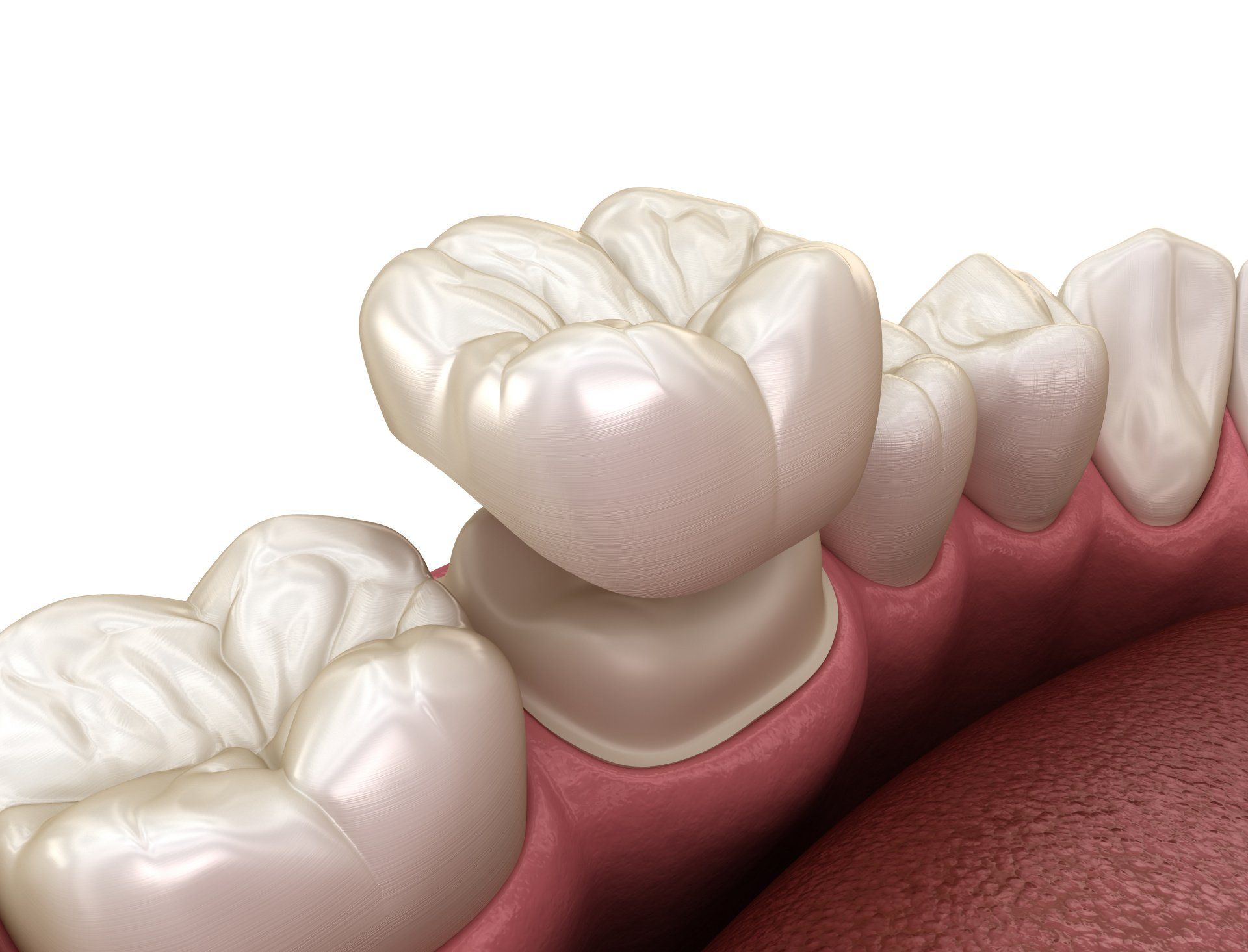 Understanding The Benefits Of Dental Zirconia Crowns