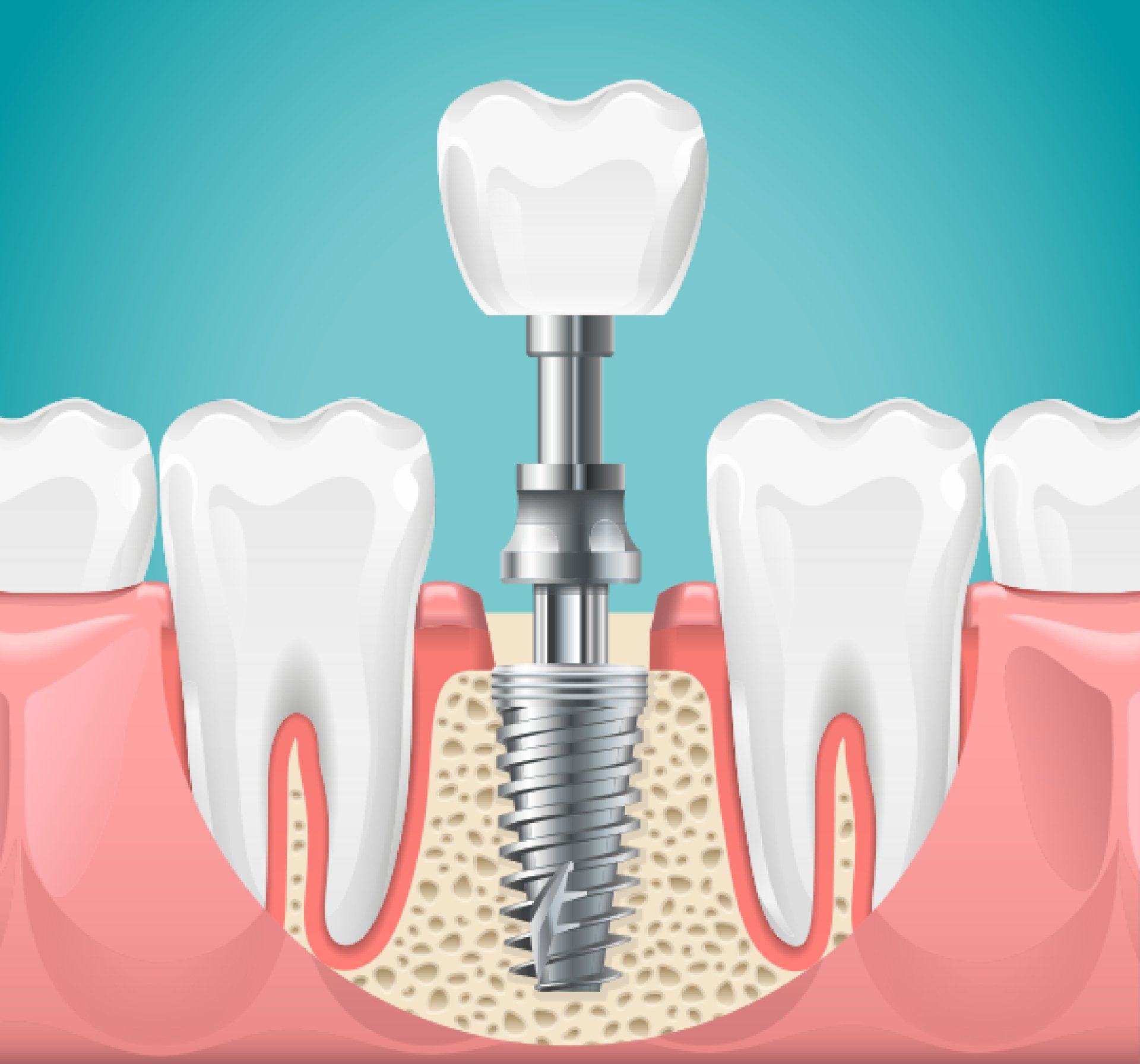 zirconium uses in dentistry