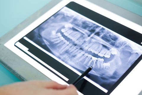 Chipped Teeth — X-Ray Of Teeth in Lexington, NE