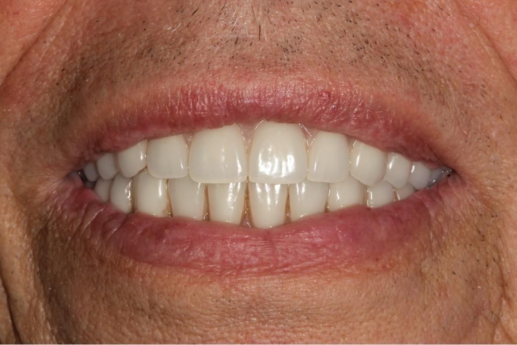 A close up of a man 's mouth with white teeth. Dental implants, full mouth rehabilitation, all-on-4 concept 