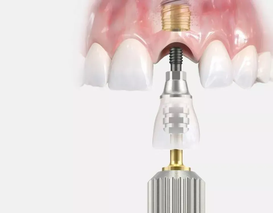 Dental implants at Newton Dental in Newton-le-Willows.