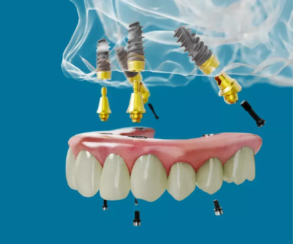 Dental implants at Newton Dental in Newton-le-Willows.