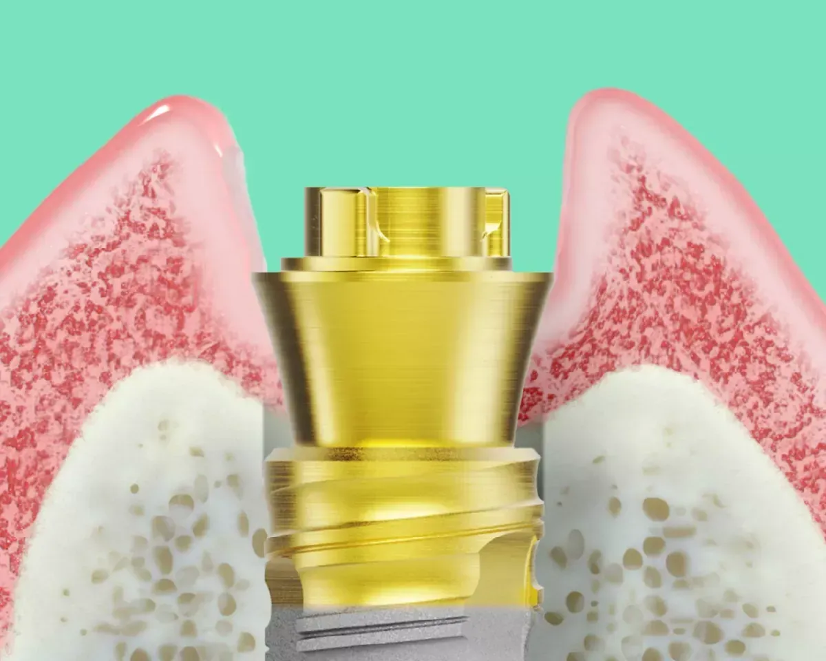 Dental implants at Newton Dental in Newton-le-Willows.