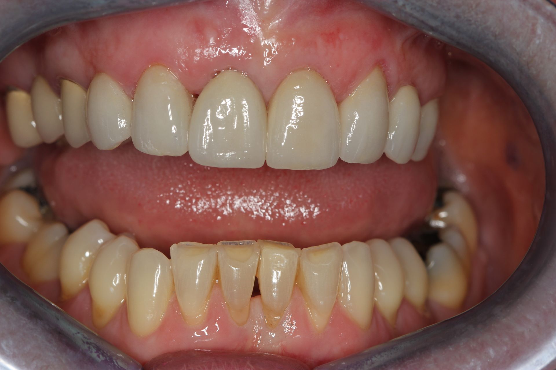 A close up of a person 's teeth in a mouth retractor. Patient has a combination of dental crown's and teeth whitening. 