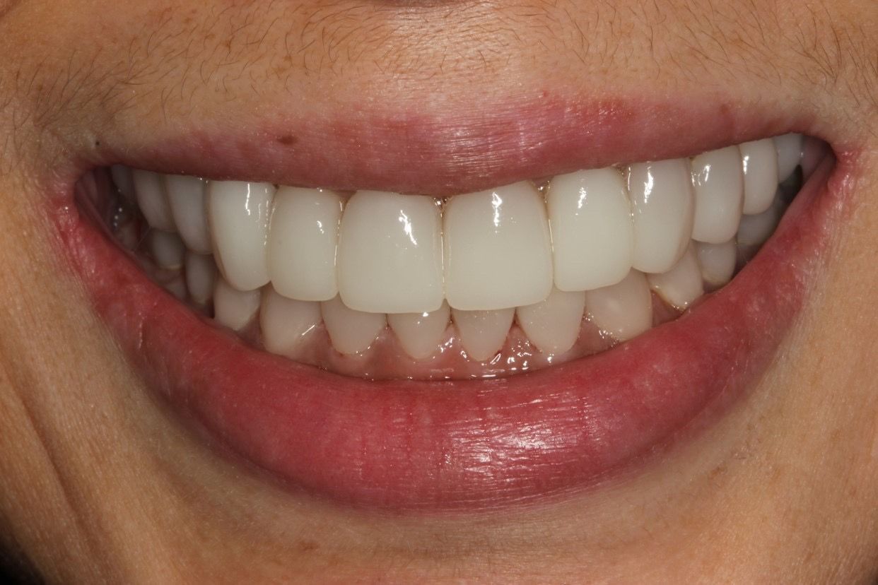 A close up of a woman 's smile with white teeth. a combination of dental implants, crowns and veneers. 