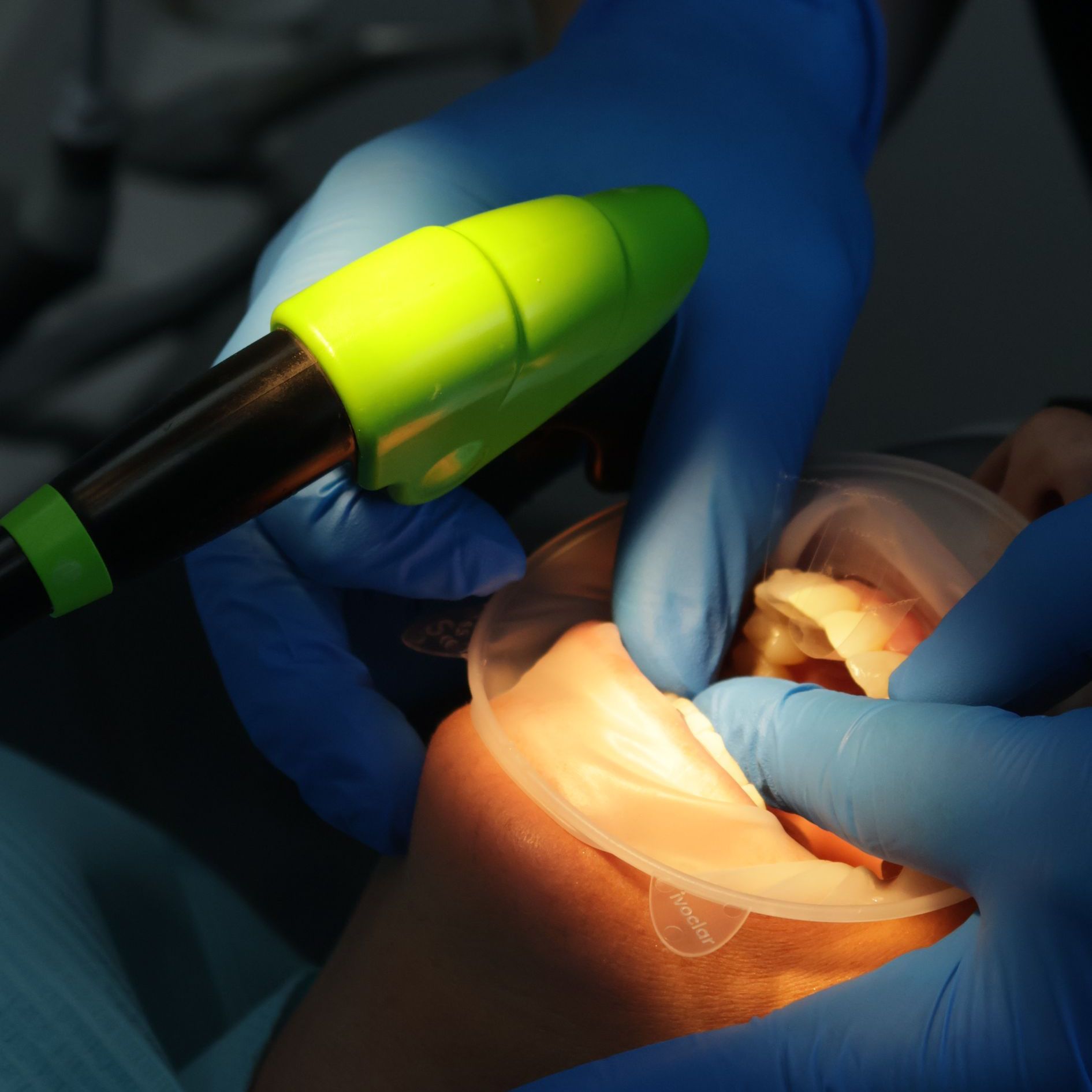 A close up of a person 's teeth on a black background. Composite bonding and teeth whitening has been performed. 