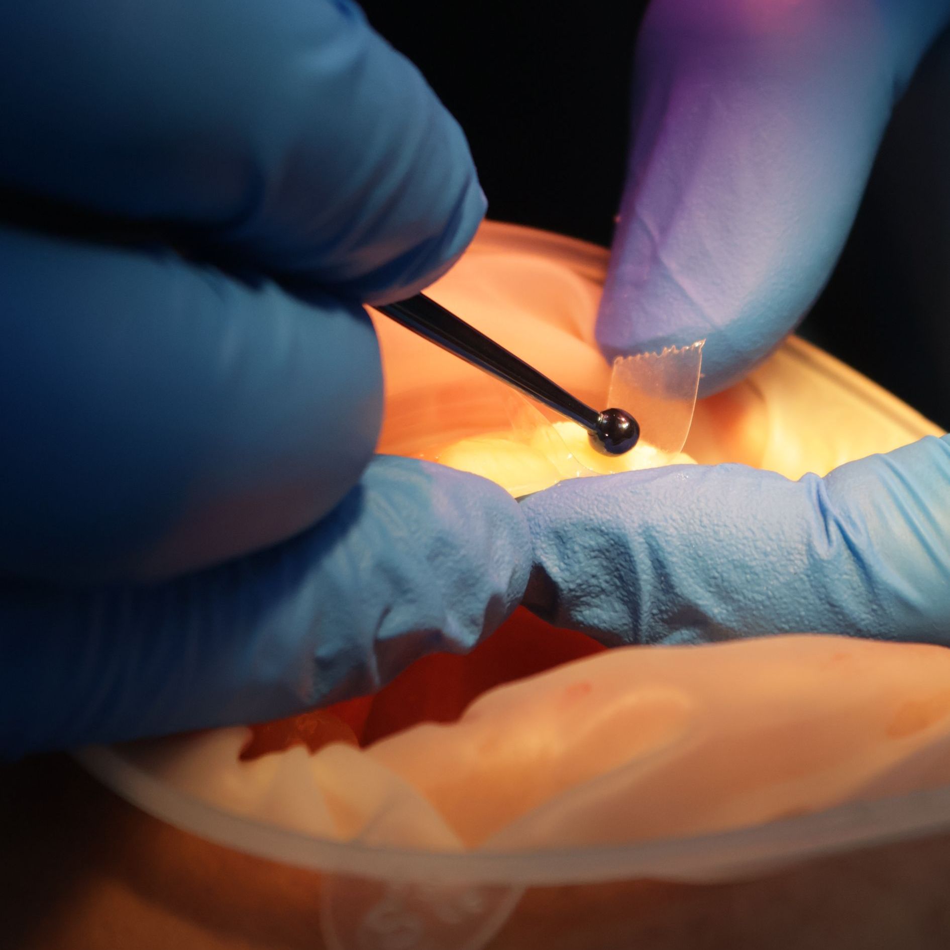 A person is getting their teeth whitened by a dentist and having composite bonding done. 