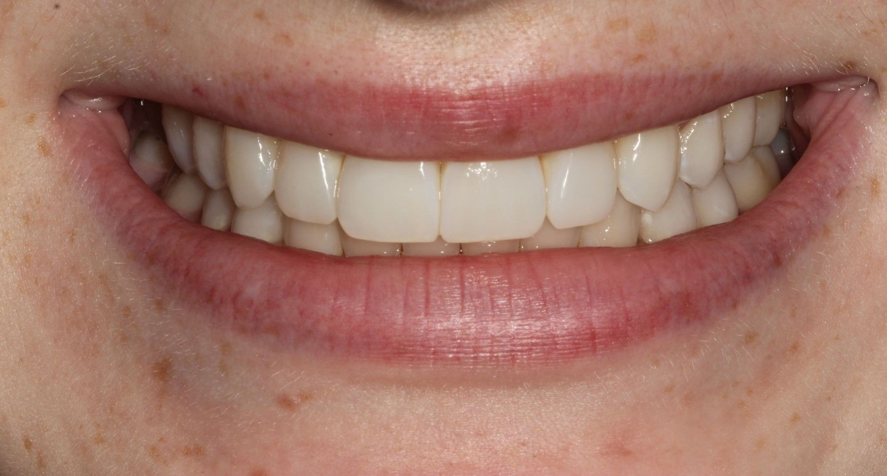 A close up of a woman 's smile with white teeth and red lips. Clear and removable braces, to create a straight smile. 