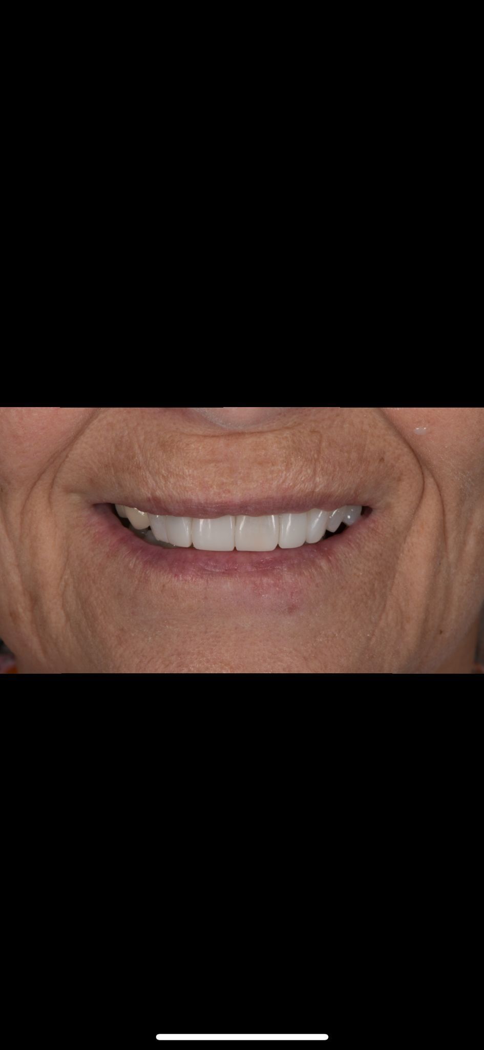 A close up of a woman 's smile with white teeth.