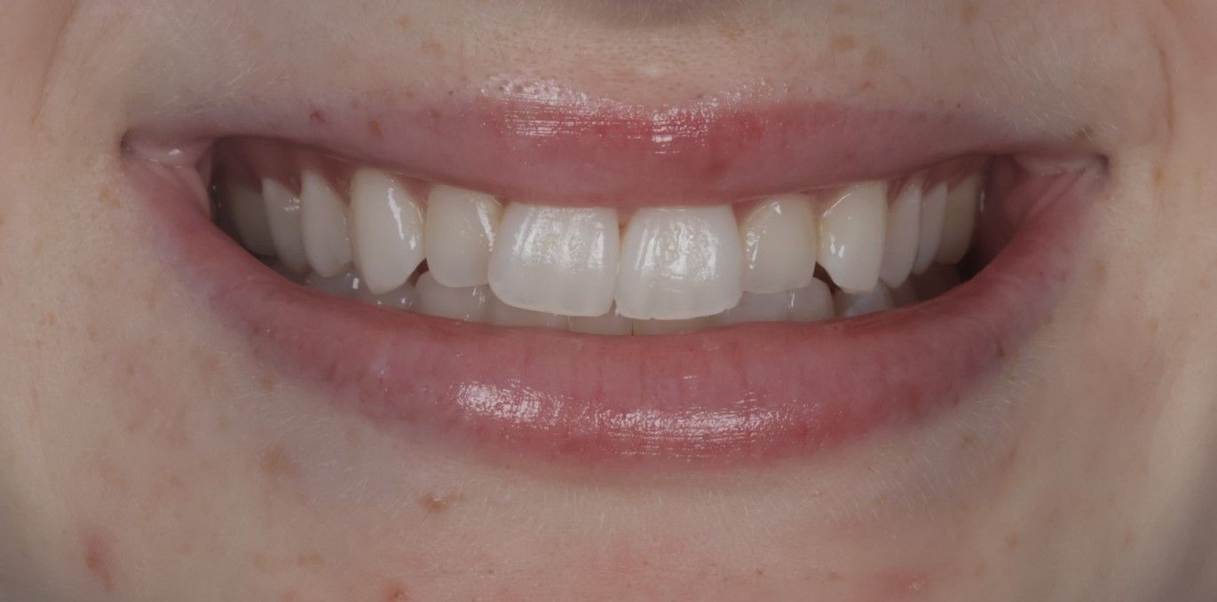 A close up of a woman 's smile with white teeth. Misaligned and crooked smile.