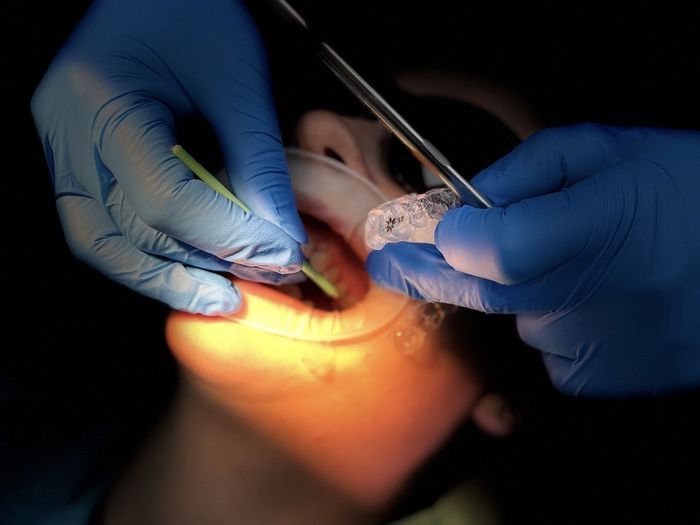 A person is getting their teeth examined by a dentist and has clear and invisible braces. 