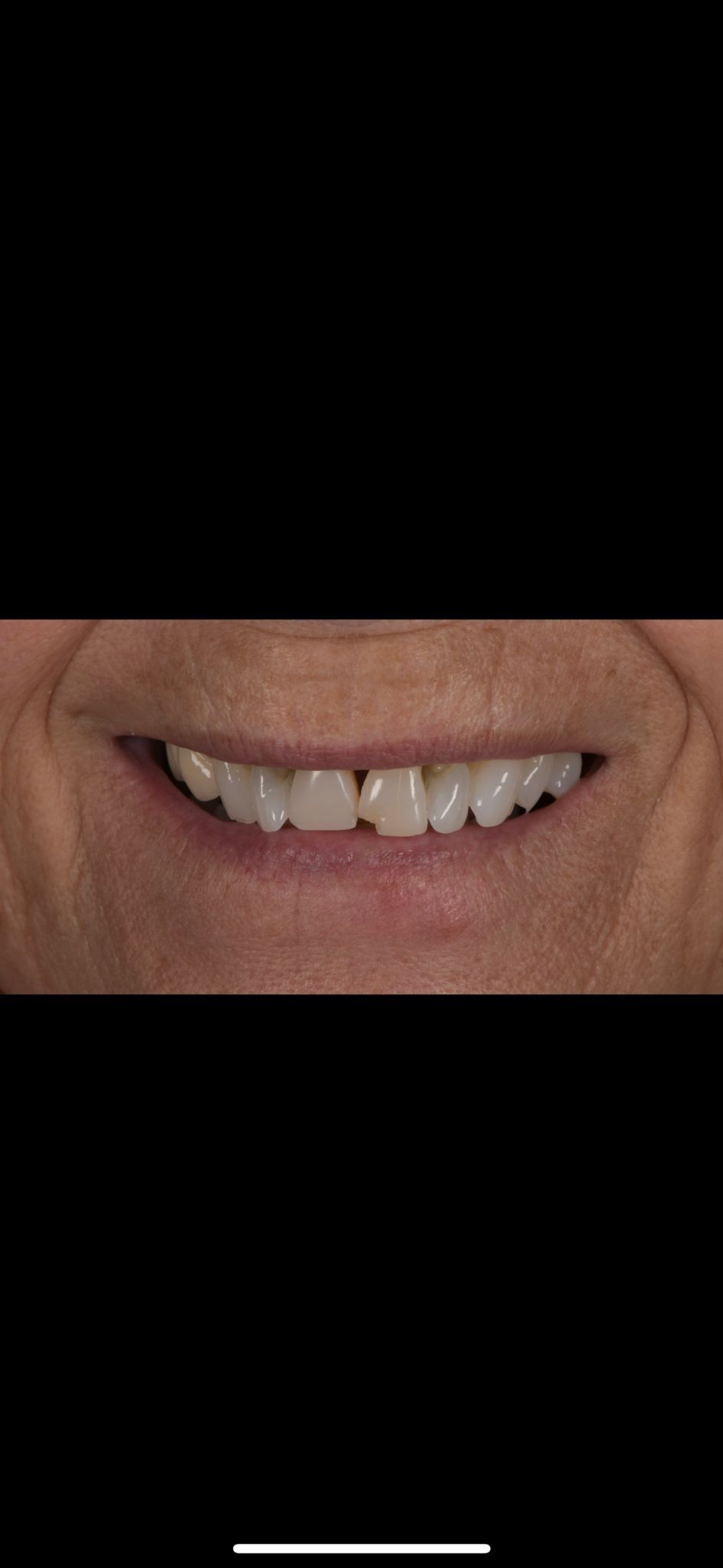 A close up of a person 's smile with a missing tooth. Patient has crooked and misaligned teeth.