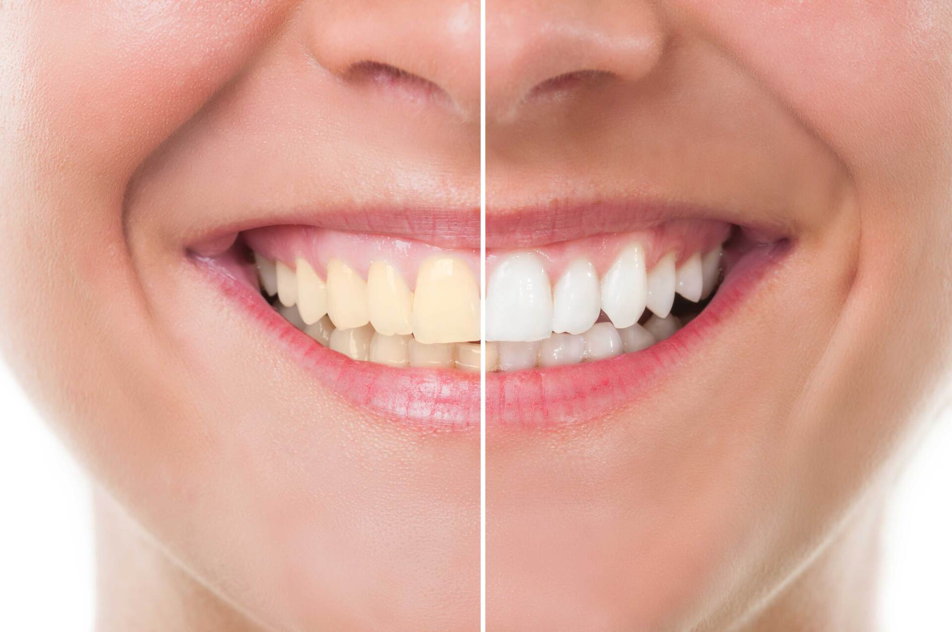 Before and After Whitening — Largo, FL — Mid County Dental Associates