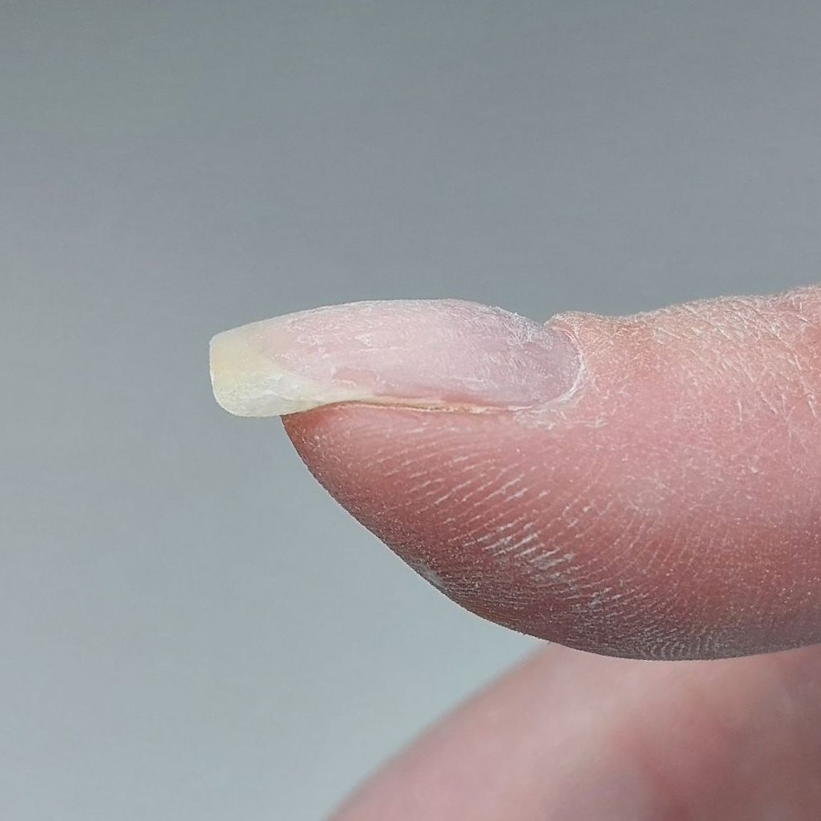 Een close-up van de vinger van een persoon met scheve nagel