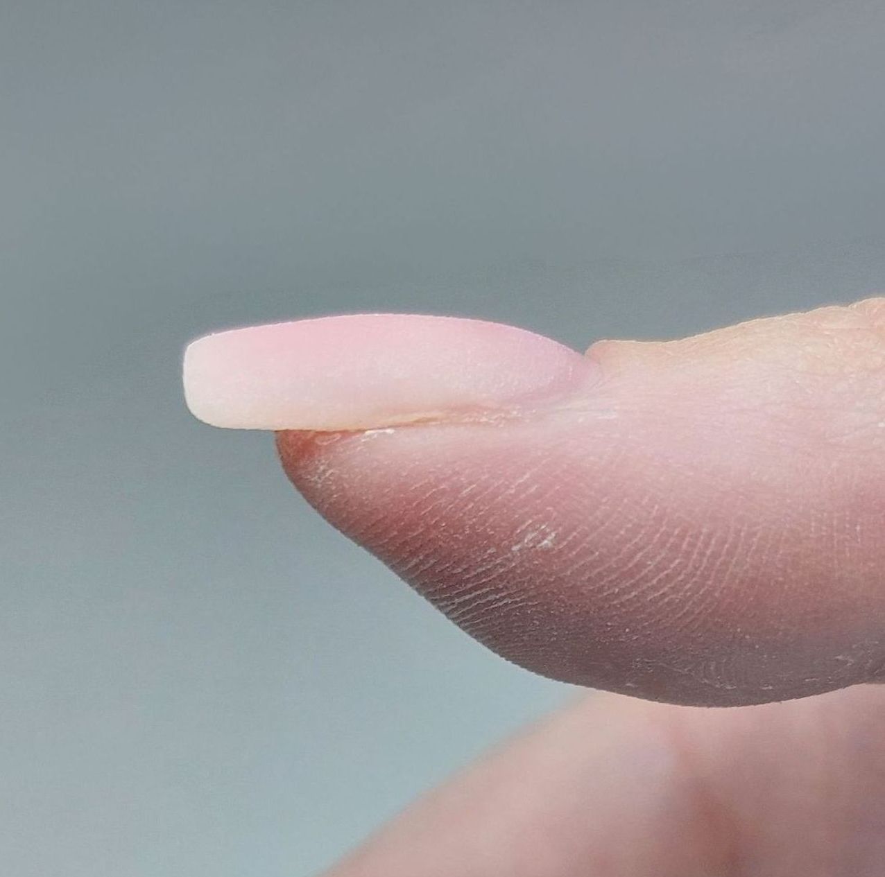 Close-up van de vinger van een persoon met een scheve nagel die gecorrigeerd is