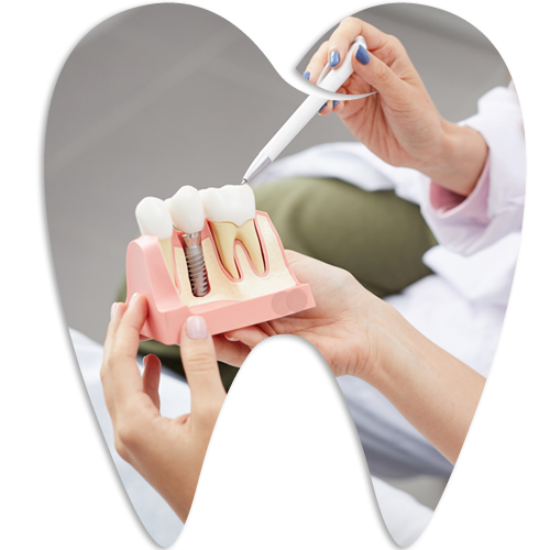 Guided Implant Surgery — Kingston, NY — Kingston Dental Associates