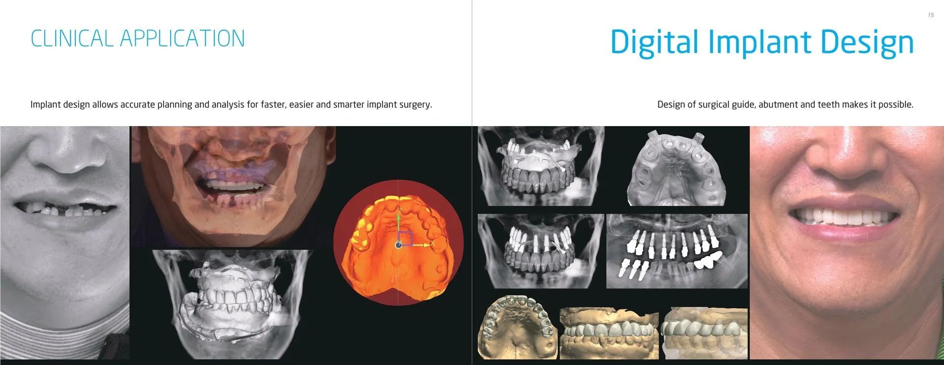 Digital Implant Design — Kingston, NY — Kingston Dental Associates
