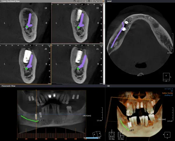 Dental CT scan with cross-sections and 3D view, showing a mandible with planned implant placement highlighted in green.