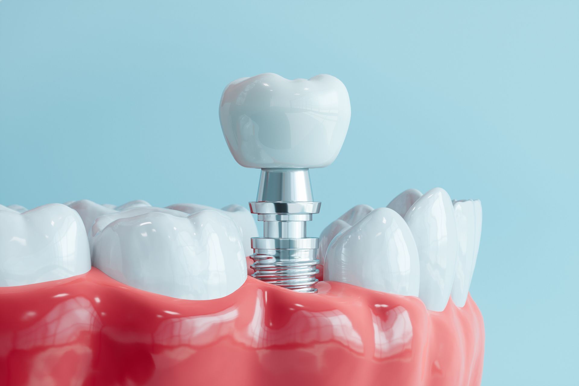 A 3D model of human gums and a dental implant with a blue background.