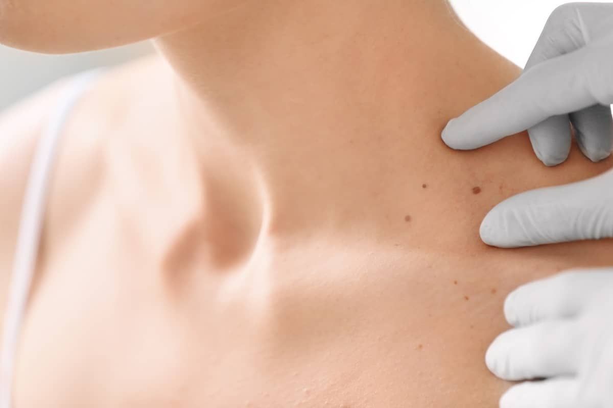 Treatment and Removal 1