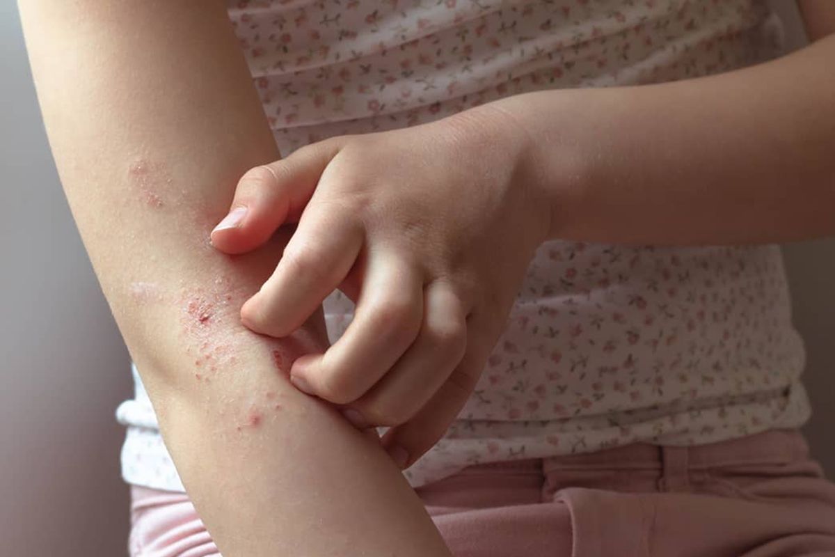 Eczema & Dermatitis 