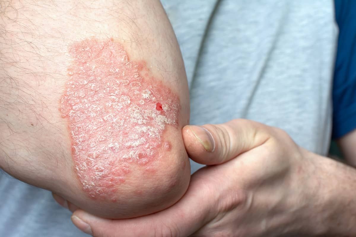 Psoriasis 