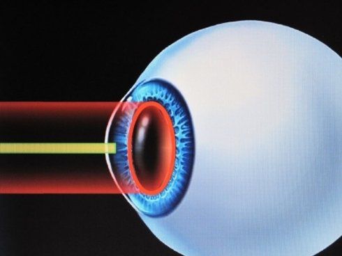 laser oculistico