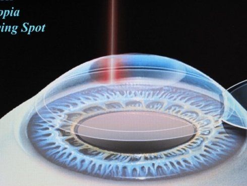 laser per chirurgia oculistica