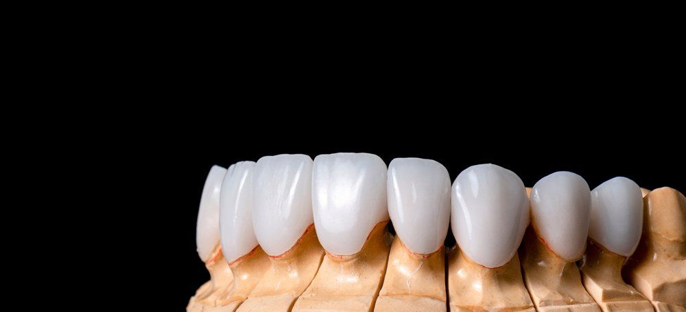 Veneers Sample In Dentures