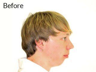 Photo of teen before jaw surgery