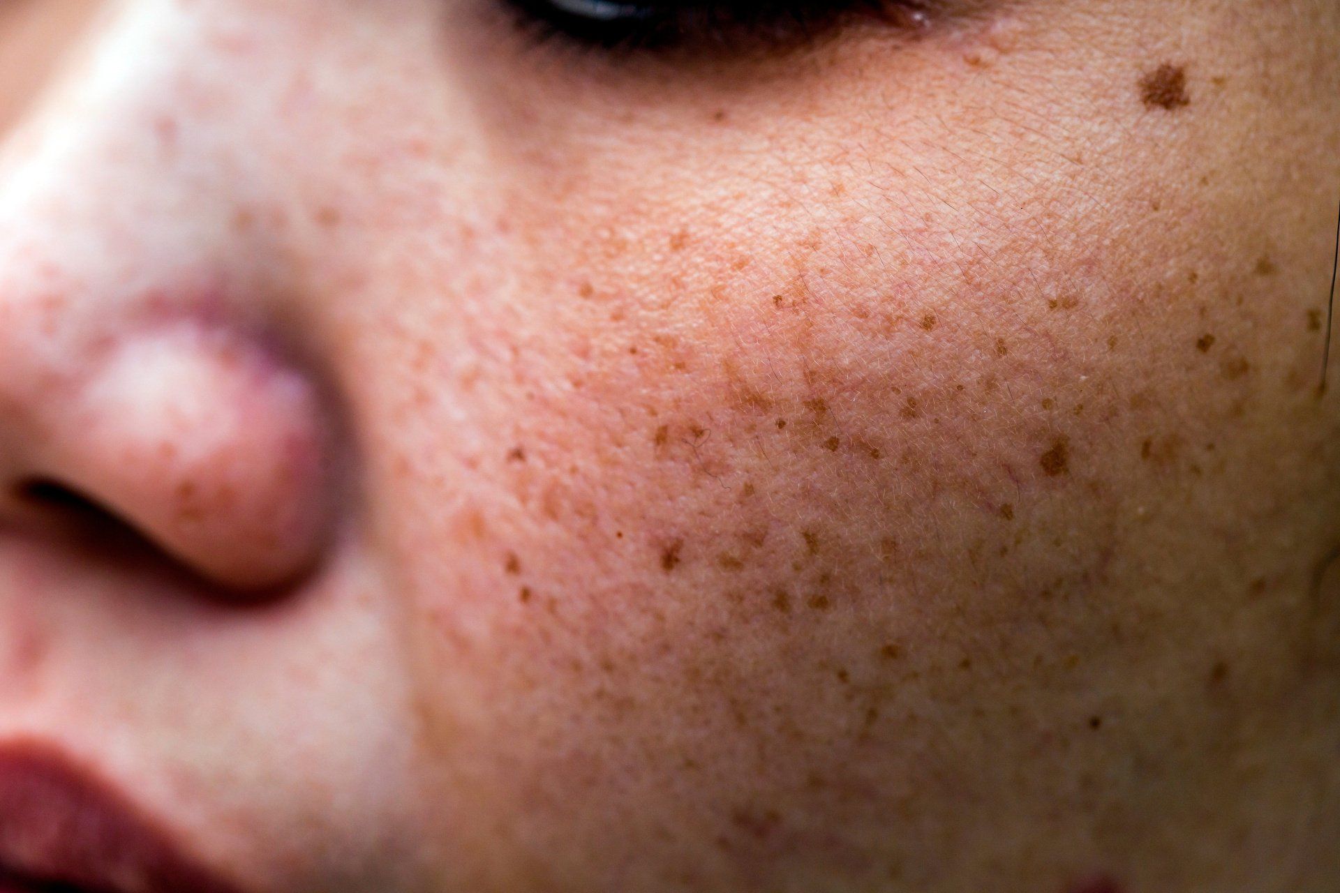 tipos de melasma