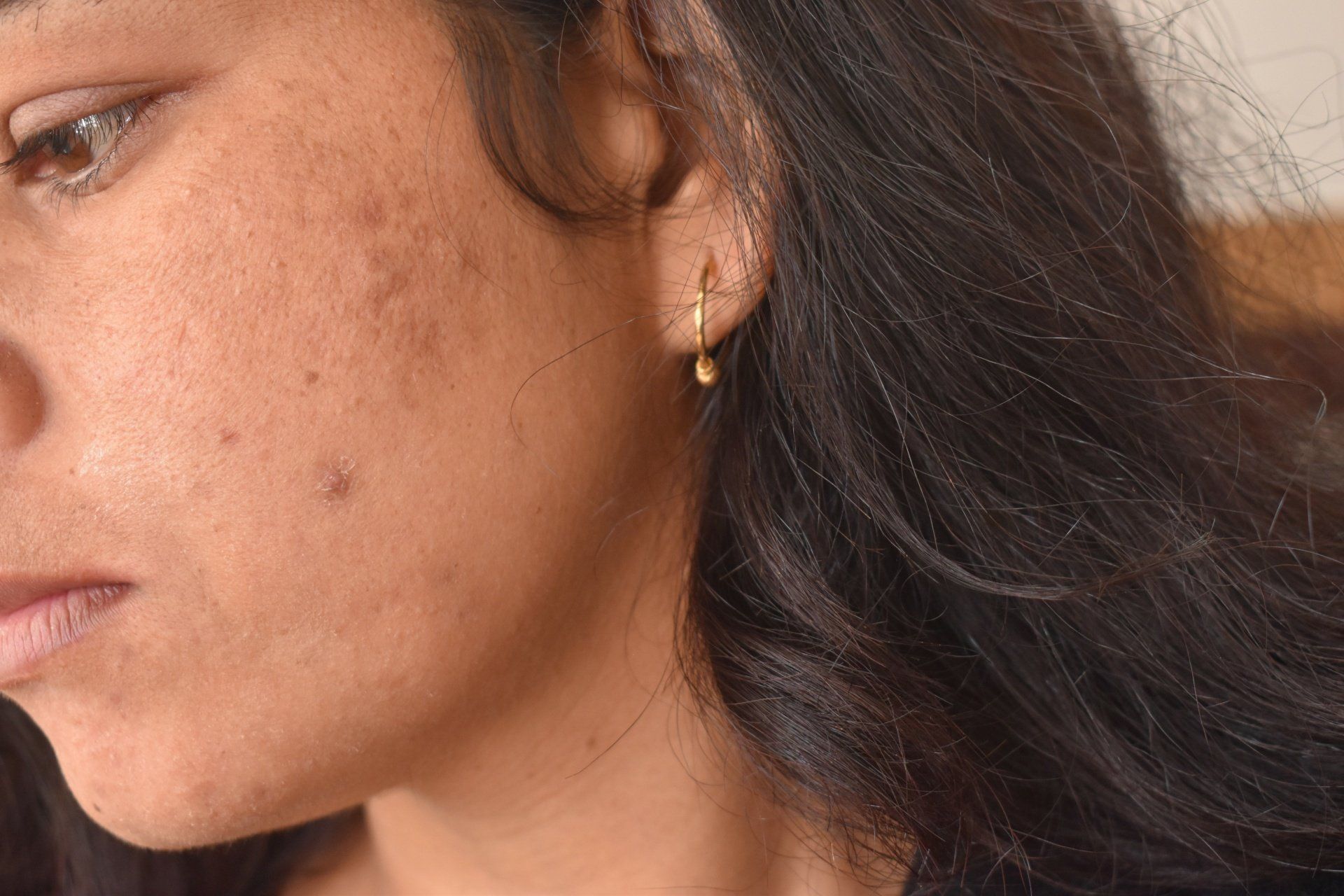 sintomas da melasma