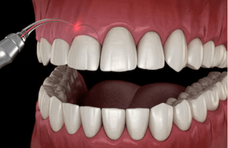 Como é feito coroa no dente