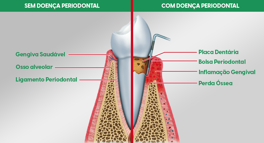 Compreendendo a doença gengival: diagnóstico e tratamento