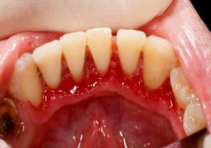 Fumar aumenta o risco de doenças periodontais, como gengivite e  periodontite, devido à redução da circulação sanguínea nas gengivas. Além…