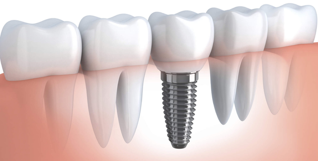 Próteses dentárias de um único molar projetadas por IA