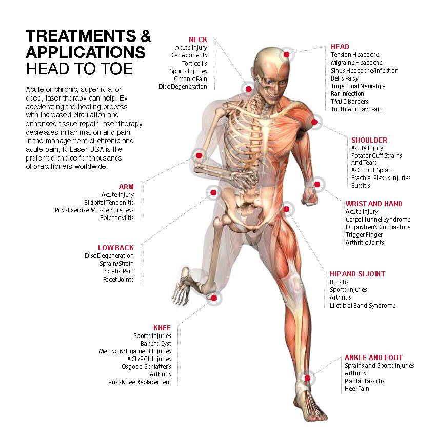 Digital illustration of a human skeleton and muscles, with pointers to various areas of the body and how the K laser can be used to treat pain
