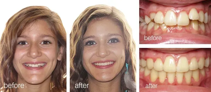 Before-and-after photos: woman's smile with crooked teeth, then straight teeth after orthodontic treatment.