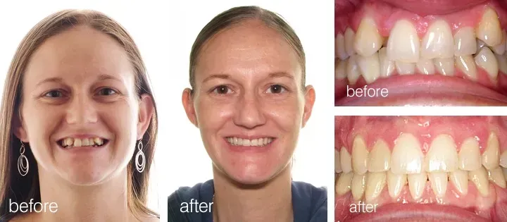 Before and after photos of a person's teeth, showing straightening and whitening.