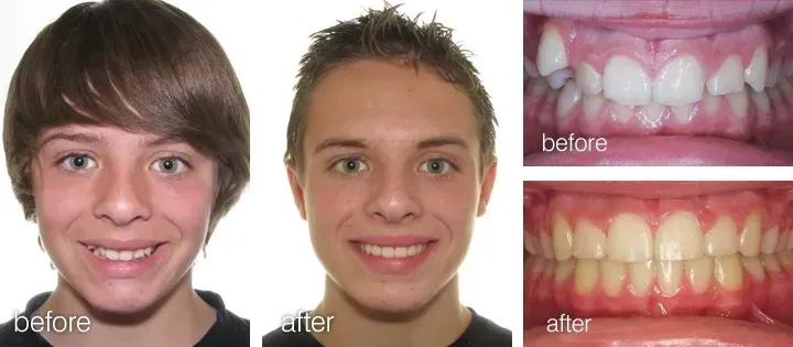 Side-by-side comparison: a person's face and teeth before and after orthodontic treatment. Teeth shift from crooked to straight.