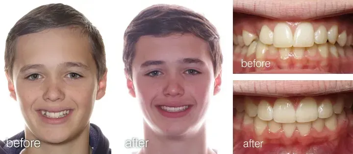 Before and after comparison of a person's teeth, showing the improvement after orthodontic treatment.