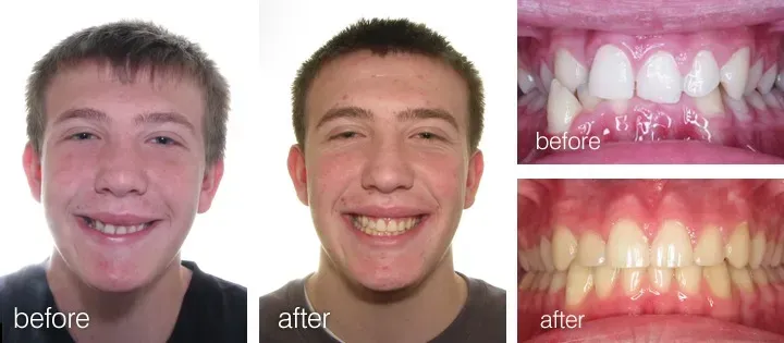 Before and after photos of a person's teeth, showing straightening achieved through dental work.
